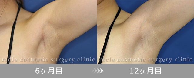 モティバ)エルゴノミクス(腋窩切開法)　傷の経過 6ヶ月目、12ヶ月目写真