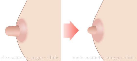 乳頭縮小施術イメージ
