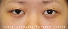 目の下の凹み(クマ) (ヒアルロン酸注入)の症例写真01 After