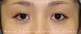 目の上の凹み(ヒアルロン酸注入)の症例写真01 After
