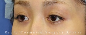 目の上の凹み(ヒアルロン酸注入)の症例写真02 After