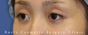 目の上の凹み(ヒアルロン酸注入)の症例写真02 Before