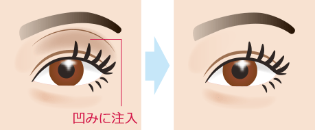 目の上の凹み(ヒアルロン酸注入)　施術イメージ