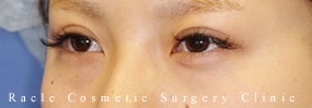 下眼瞼下制術 埋没法(たれ目術)の症例写真02 Before