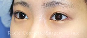 下眼瞼下制術 埋没法(たれ目術)の症例写真03 After