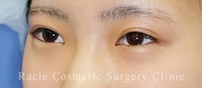 下眼瞼下制術 埋没法(たれ目術)の症例写真03 Before