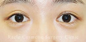 下眼瞼下制術 埋没法(たれ目術)の症例写真04 After