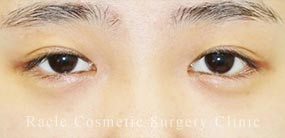 下眼瞼下制術 埋没法(たれ目術)の症例写真04 Before