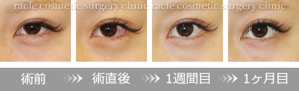 下眼瞼下制術 埋没法(たれ目術)のダウンタイム　イメージ