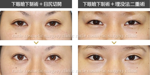 目尻切開＋下眼瞼下制術 埋没法(たれ目術)　イメージ