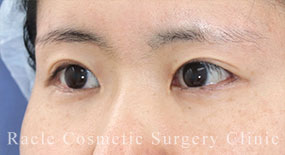 目尻拡大術(白目拡大)の症例写真15 After