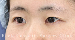 目尻拡大術(白目拡大)の症例写真15 Before