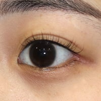 下眼瞼下制術 切開法(たれ目術・グラマラスライン形成) 症例写真 施術後