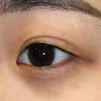 下眼瞼下制術 切開法(たれ目術・グラマラスライン形成) 症例写真 施術前