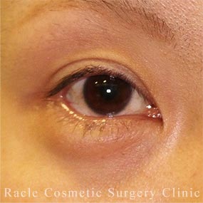 下眼瞼下制術 結膜側切開法(たれ目術・グラマラスライン形成)の症例写真 After