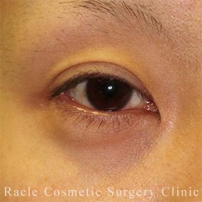 下眼瞼下制術 結膜側切開法(たれ目術・グラマラスライン形成)の症例写真 Before