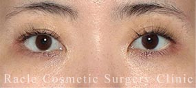 下眼瞼下制術 皮膚切開法(たれ目術・グラマラスライン形成)＋目尻切開の症例写真 After
