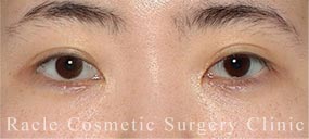 下眼瞼下制術 皮膚切開法(たれ目術・グラマラスライン形成)＋目尻切開の症例写真 Before
