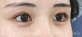 下眼瞼下制術 皮膚切開法(たれ目術・グラマラスライン形成)＋目尻切開＋目頭切開＋眉下切開法の症例写真04 After