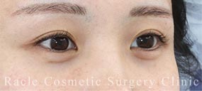 下眼瞼下制術 皮膚切開法(たれ目術・グラマラスライン形成)＋目尻切開＋目頭切開＋眉下切開法の症例写真04 Before