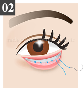 皮膚切開法 Step.2