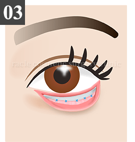 皮膚切開法 Step.3