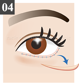 皮膚切開法 Step.4