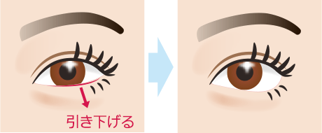 下眼瞼下制術 切開法(たれ目術・グラマラスライン形成)　施術イメージ