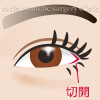 目尻切開イメージ