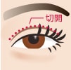 眼瞼下垂(挙筋腱膜前転法)イメージ