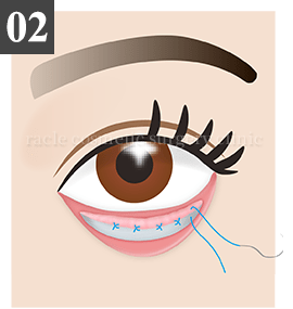 結膜側切開法 Step.2