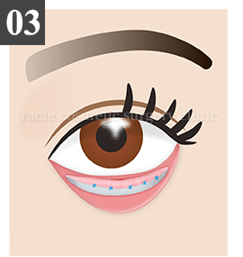 結膜側切開法 Step.3