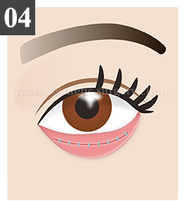 結膜側切開法 Step.4