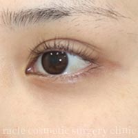 裏ハムラ法 症例写真 施術後