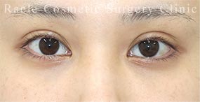 ハムラ法(裏ハムラ法)の症例写真03 After