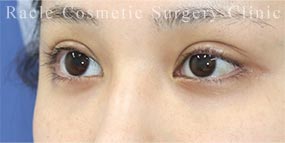 ハムラ法(裏ハムラ法)の症例写真04 After