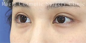 ハムラ法(裏ハムラ法)の症例写真04 Before