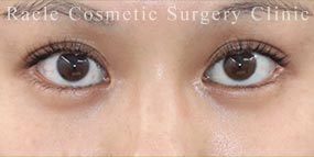 ハムラ法(裏ハムラ法)の症例写真05 After