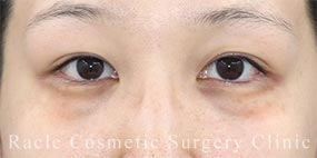 ハムラ法(裏ハムラ法)の症例写真06 Before