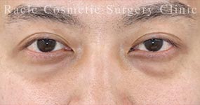 ハムラ法(裏ハムラ法)の症例写真07 Before