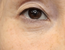 術後の目のシワ　イメージ