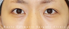 切らない眼瞼下垂の症例写真02 After