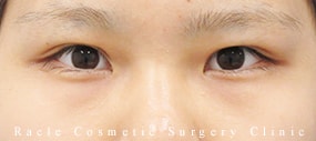 切らない眼瞼下垂の症例写真01 After