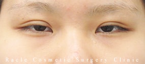 切らない眼瞼下垂の症例写真01 Before