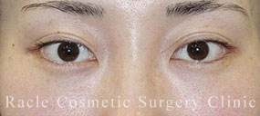 切らない眼瞼下垂の症例写真04 After