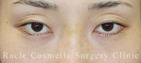 切らない眼瞼下垂の症例写真04 Before