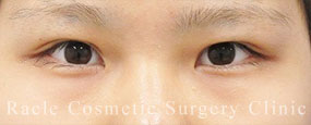 切らない眼瞼下垂の症例写真05 After