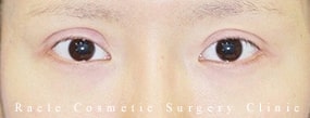 眼瞼下垂(挙筋腱膜前転法)の症例写真01 After