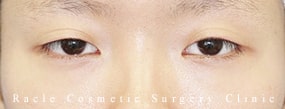 眼瞼下垂(挙筋腱膜前転法)の症例写真01 Before