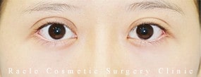 眼瞼下垂(挙筋腱膜前転法)の症例写真02 After